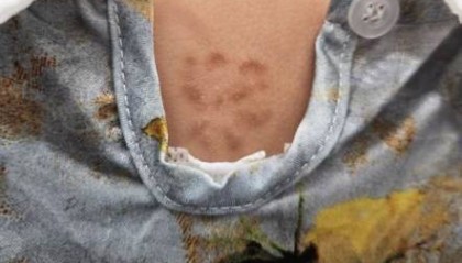 杭州5岁女孩背上惊现“梅花印”，罪魁祸首竟是家里的……