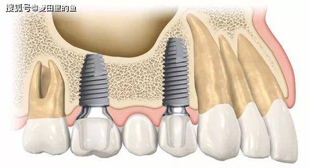 种植牙当天就可以种吗?